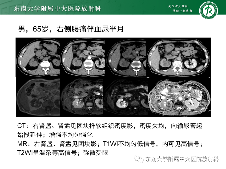 影像PPT - 【PPT】肾脏上皮样血管平滑肌脂肪瘤-23