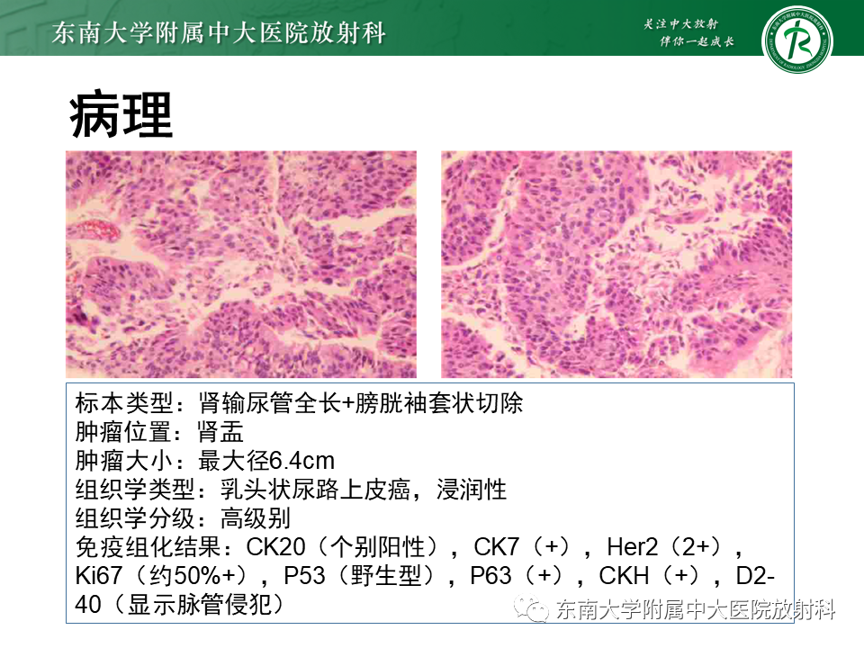 影像PPT - 【PPT】肾脏上皮样血管平滑肌脂肪瘤-24