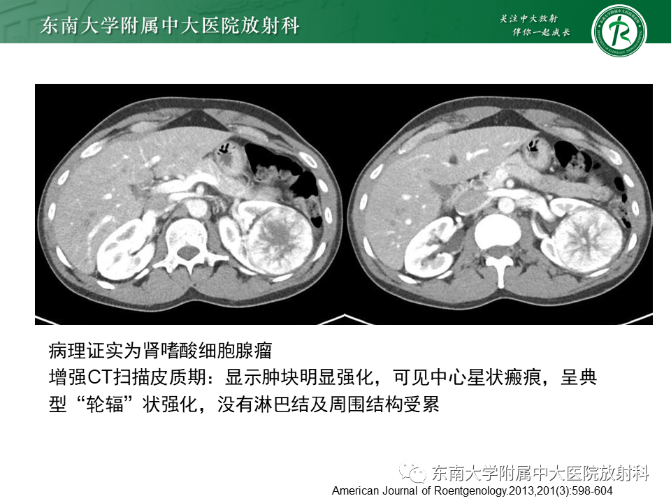 影像PPT - 【PPT】肾脏上皮样血管平滑肌脂肪瘤-29