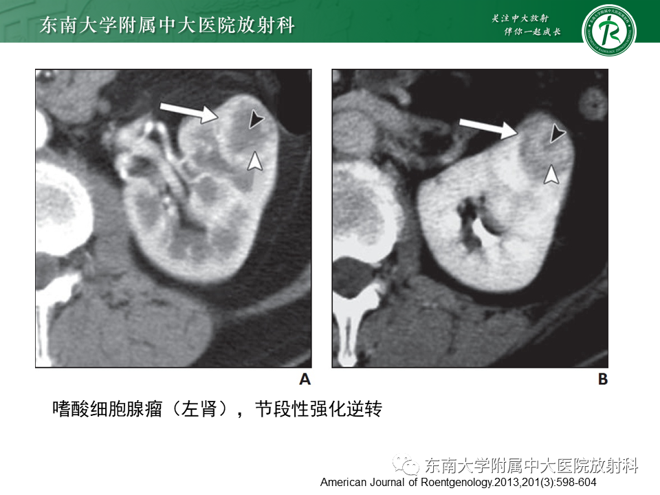 影像PPT - 【PPT】肾脏上皮样血管平滑肌脂肪瘤-30