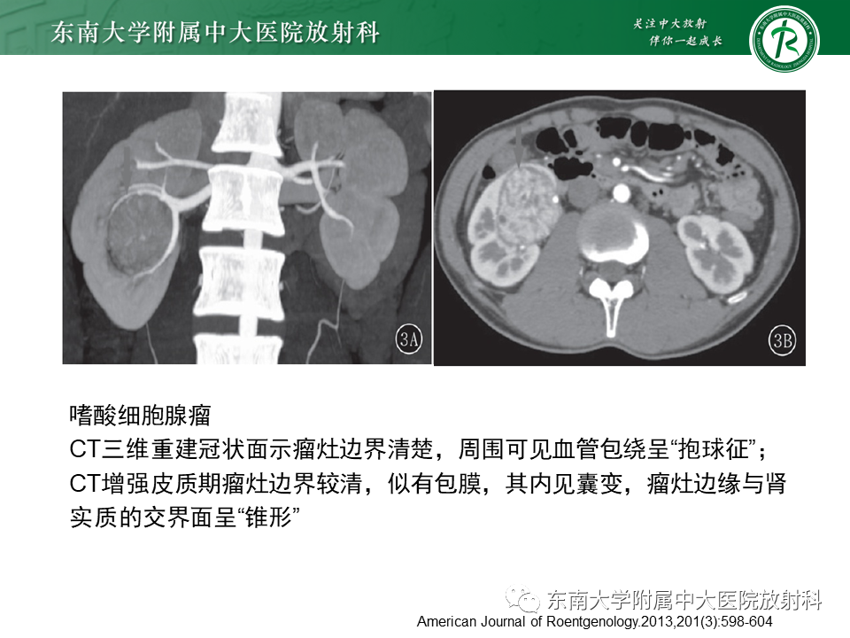 影像PPT - 【PPT】肾脏上皮样血管平滑肌脂肪瘤-31