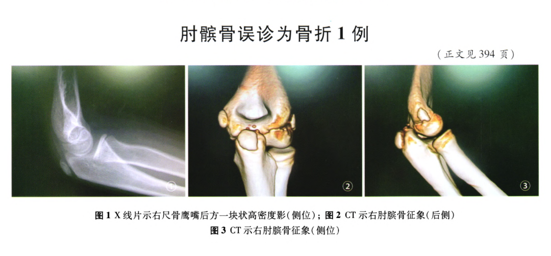 影像PPT - 【病例】肘关节也有髌骨?“肘髌骨”你知道吗?-4 影像PPT - 【病例】肘关节也有髌骨?“肘髌骨”你知道吗?-4