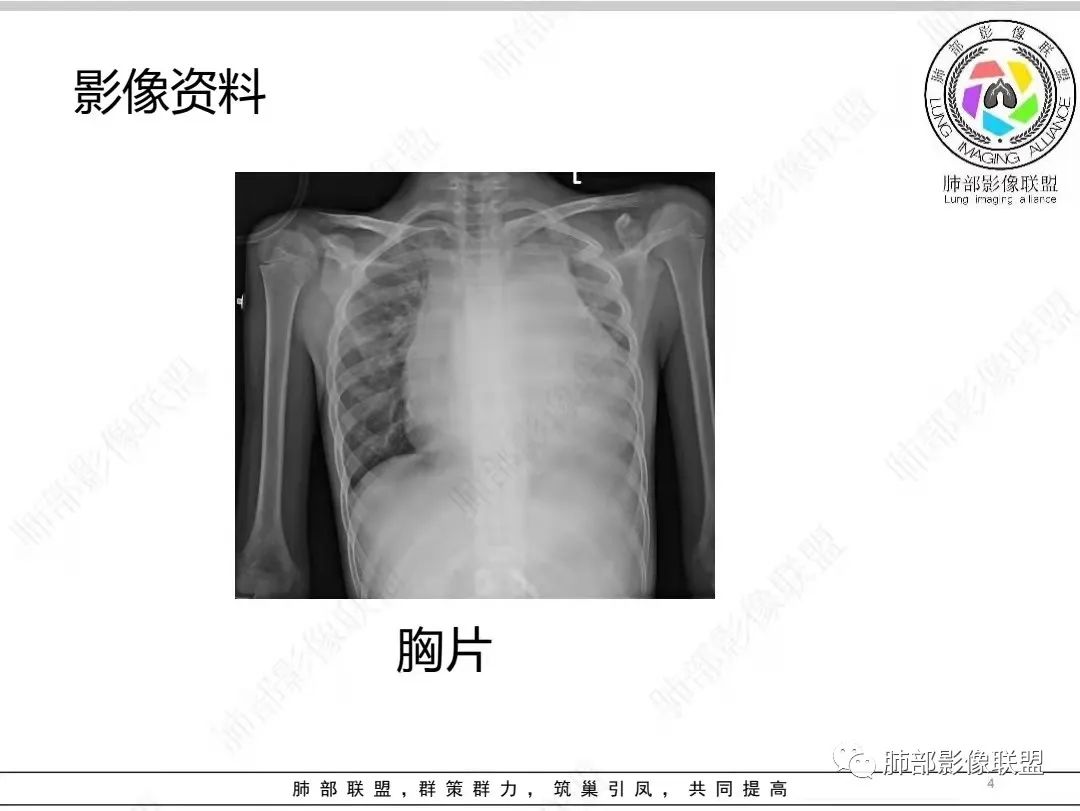 影像PPT - 【病例】纵隔/心脏毛霉菌病1例CT影像-4 影像PPT - 【病例】纵隔/心脏毛霉菌病1例CT影像-4