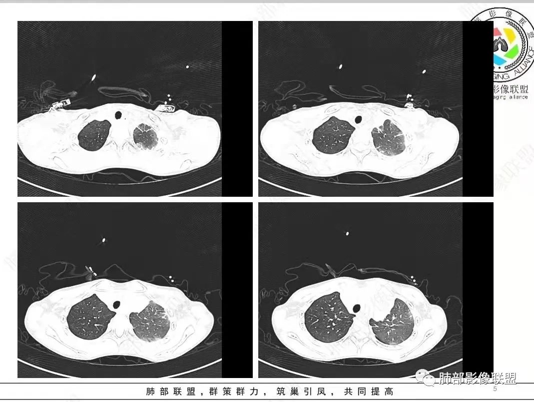 影像PPT - 【病例】纵隔/心脏毛霉菌病1例CT影像-5 影像PPT - 【病例】纵隔/心脏毛霉菌病1例CT影像-5