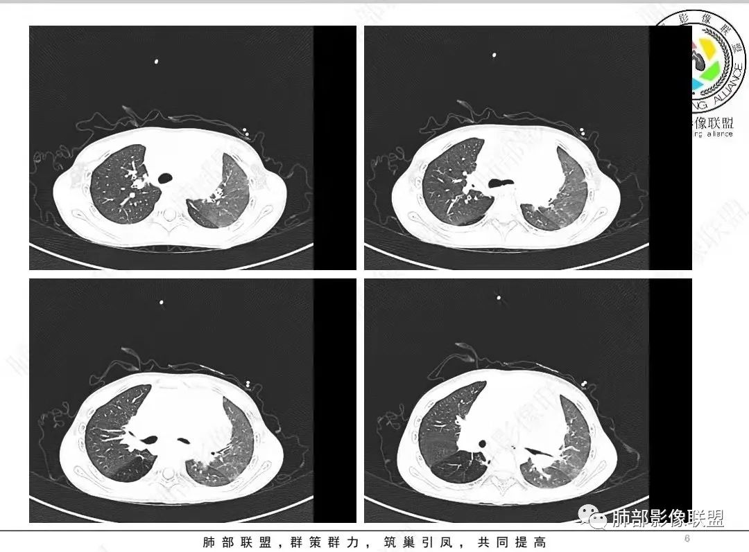 影像PPT - 【病例】纵隔/心脏毛霉菌病1例CT影像-6 影像PPT - 【病例】纵隔/心脏毛霉菌病1例CT影像-6
