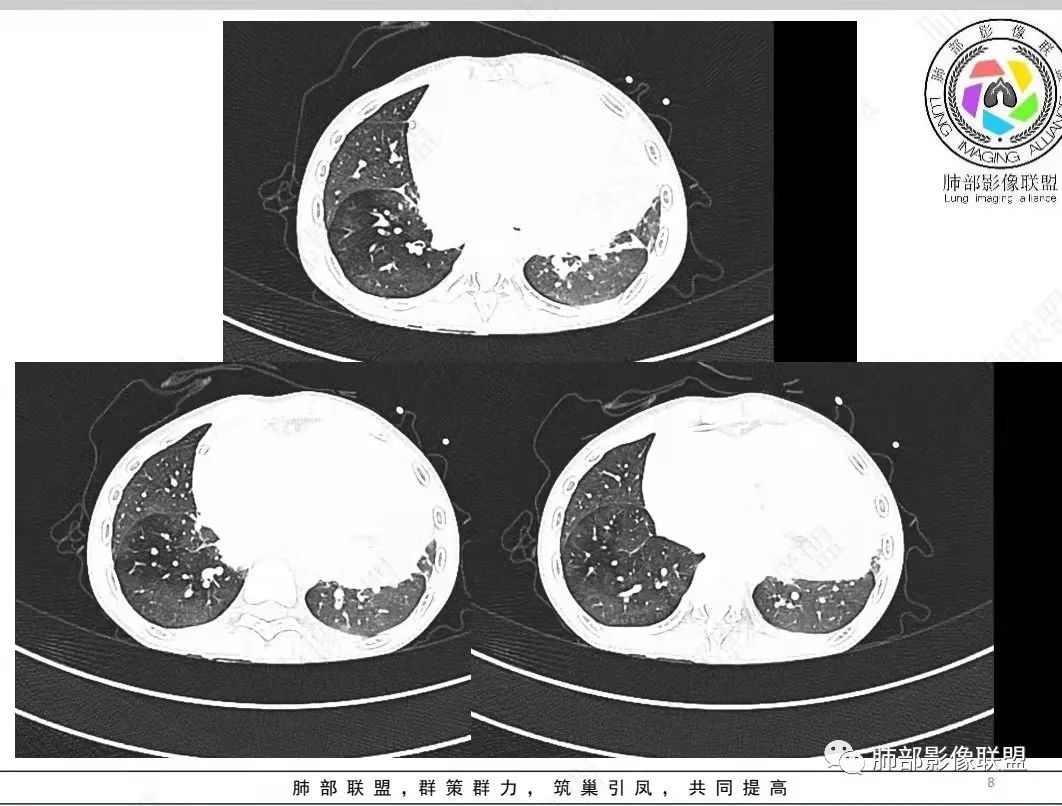 影像PPT - 【病例】纵隔/心脏毛霉菌病1例CT影像-8 影像PPT - 【病例】纵隔/心脏毛霉菌病1例CT影像-8
