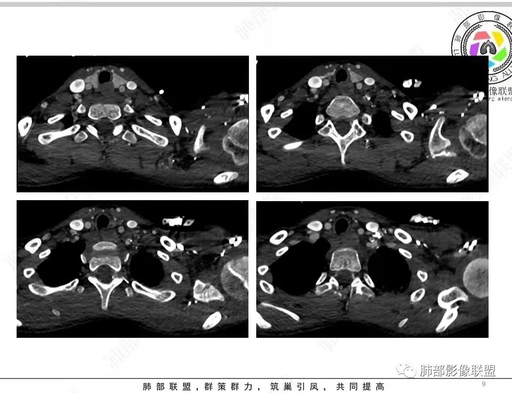 影像PPT - 【病例】纵隔/心脏毛霉菌病1例CT影像-9 影像PPT - 【病例】纵隔/心脏毛霉菌病1例CT影像-9