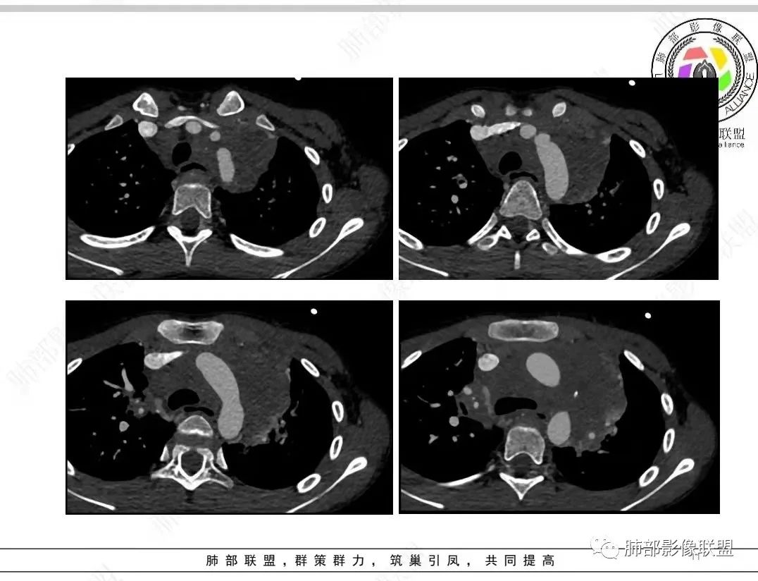 影像PPT - 【病例】纵隔/心脏毛霉菌病1例CT影像-11 影像PPT - 【病例】纵隔/心脏毛霉菌病1例CT影像-11