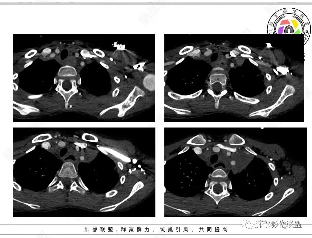 影像PPT - 【病例】纵隔/心脏毛霉菌病1例CT影像-10 影像PPT - 【病例】纵隔/心脏毛霉菌病1例CT影像-10