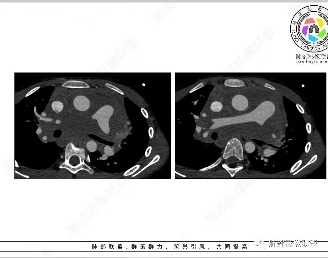 影像PPT - 【病例】纵隔/心脏毛霉菌病1例CT影像-13 影像PPT - 【病例】纵隔/心脏毛霉菌病1例CT影像-13