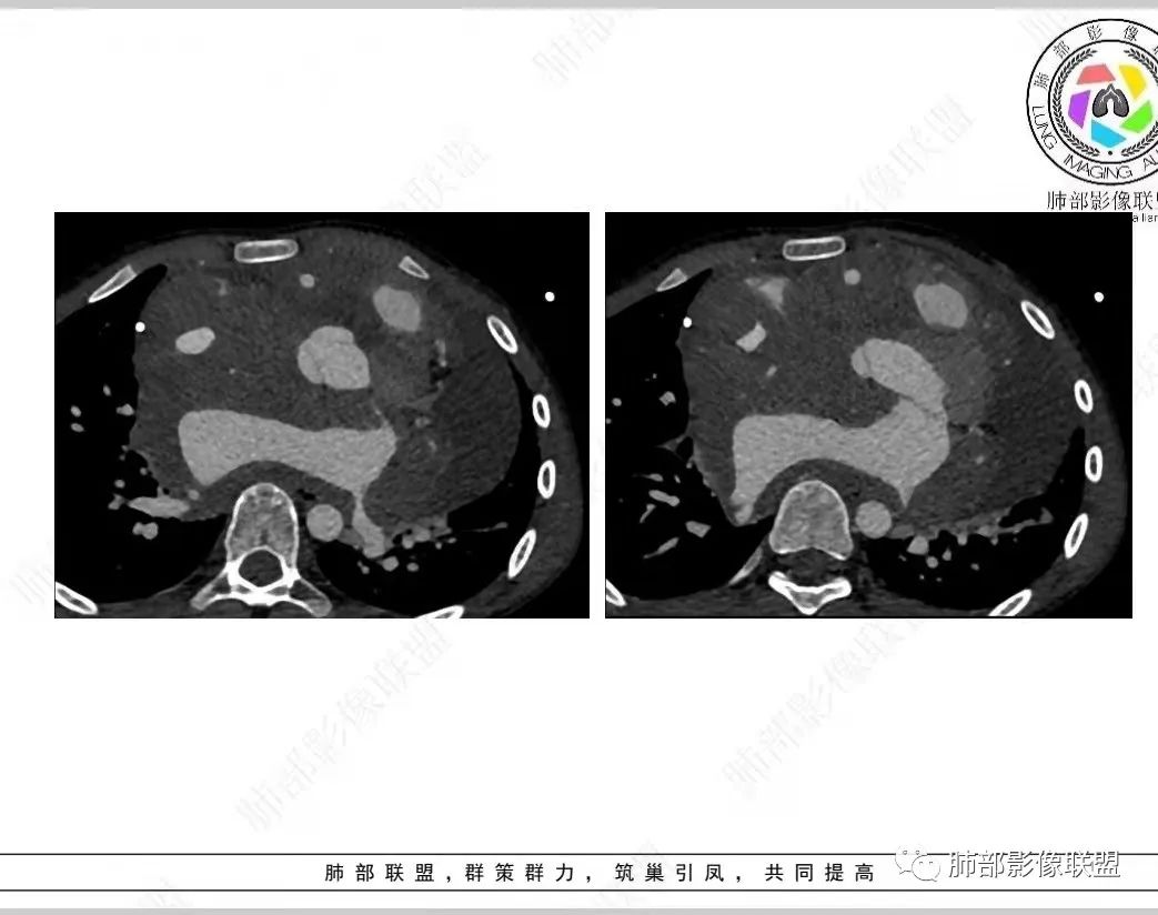 影像PPT - 【病例】纵隔/心脏毛霉菌病1例CT影像-17 影像PPT - 【病例】纵隔/心脏毛霉菌病1例CT影像-17