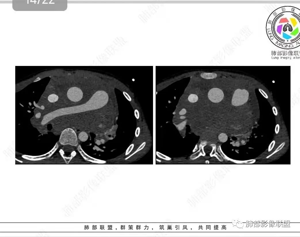 影像PPT - 【病例】纵隔/心脏毛霉菌病1例CT影像-14 影像PPT - 【病例】纵隔/心脏毛霉菌病1例CT影像-14