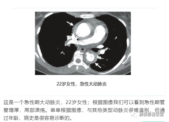 影像PPT - 【病例】纵隔/心脏毛霉菌病1例CT影像-44 影像PPT - 【病例】纵隔/心脏毛霉菌病1例CT影像-44