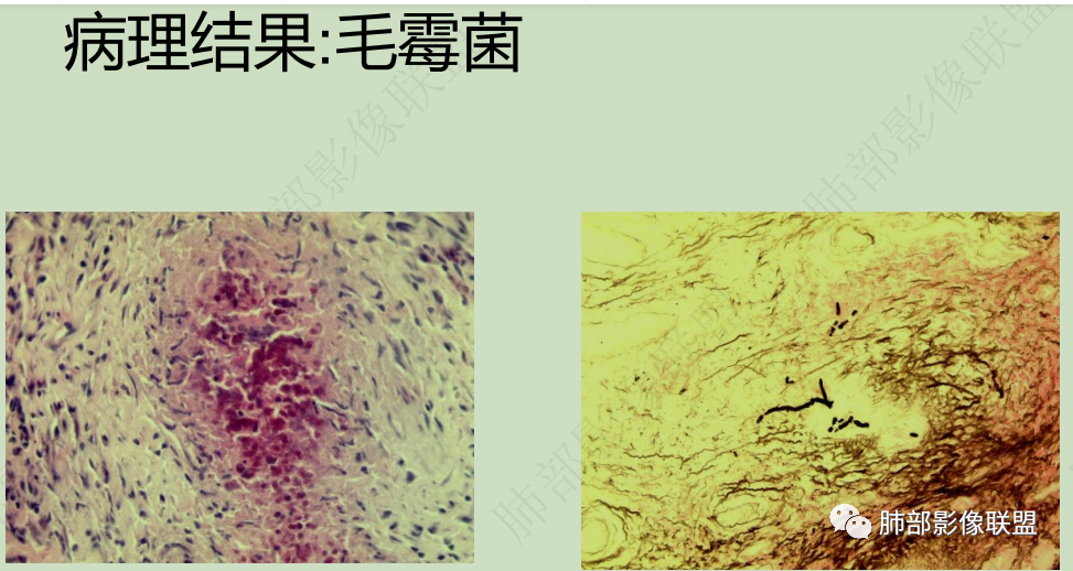影像PPT - 【病例】纵隔/心脏毛霉菌病1例CT影像-42 影像PPT - 【病例】纵隔/心脏毛霉菌病1例CT影像-42