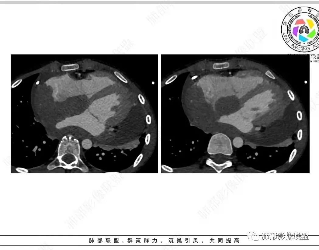 影像PPT - 【病例】纵隔/心脏毛霉菌病1例CT影像-19 影像PPT - 【病例】纵隔/心脏毛霉菌病1例CT影像-19