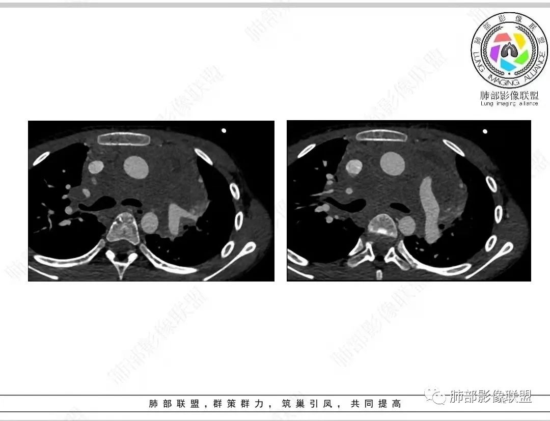 影像PPT - 【病例】纵隔/心脏毛霉菌病1例CT影像-12 影像PPT - 【病例】纵隔/心脏毛霉菌病1例CT影像-12