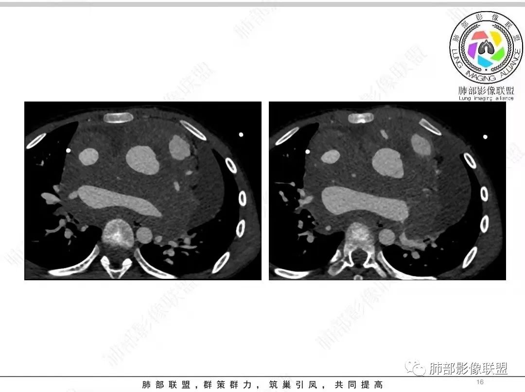 影像PPT - 【病例】纵隔/心脏毛霉菌病1例CT影像-16 影像PPT - 【病例】纵隔/心脏毛霉菌病1例CT影像-16