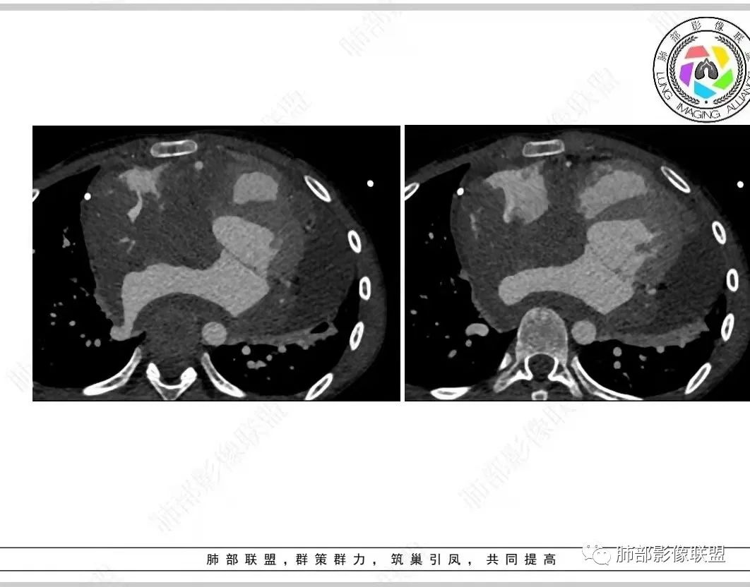 影像PPT - 【病例】纵隔/心脏毛霉菌病1例CT影像-18 影像PPT - 【病例】纵隔/心脏毛霉菌病1例CT影像-18