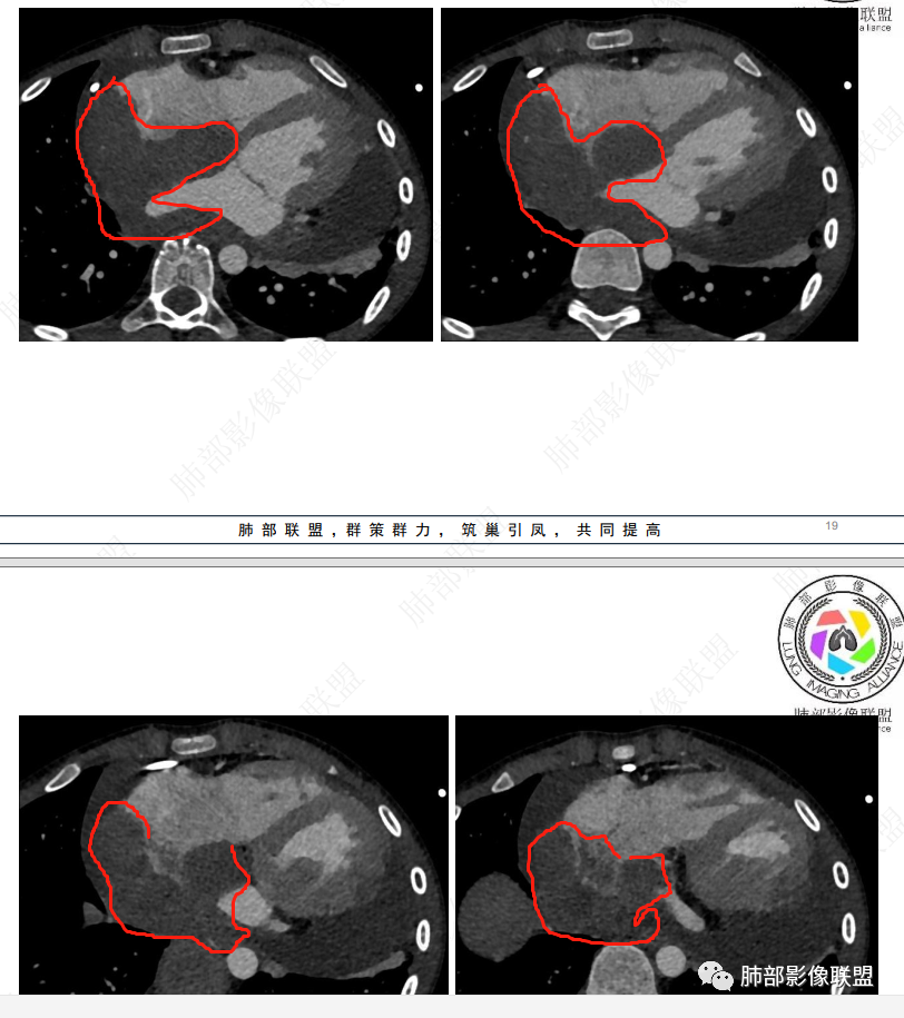 影像PPT - 【病例】纵隔/心脏毛霉菌病1例CT影像-34 影像PPT - 【病例】纵隔/心脏毛霉菌病1例CT影像-34