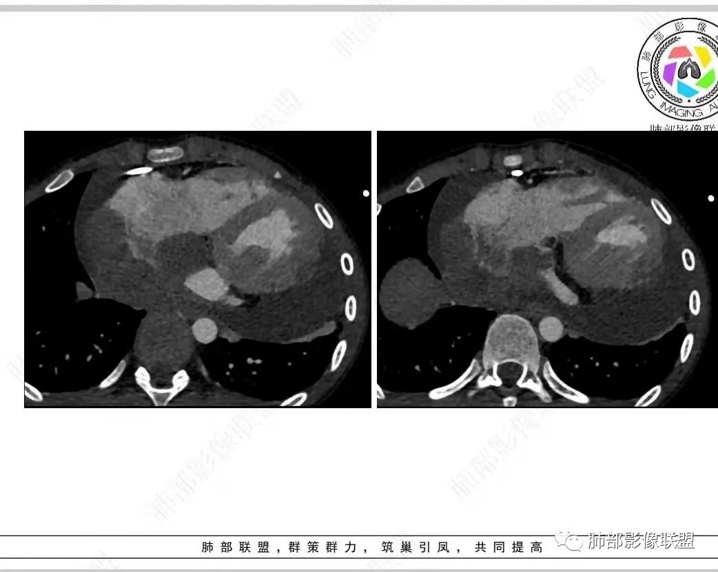 影像PPT - 【病例】纵隔/心脏毛霉菌病1例CT影像-20 影像PPT - 【病例】纵隔/心脏毛霉菌病1例CT影像-20