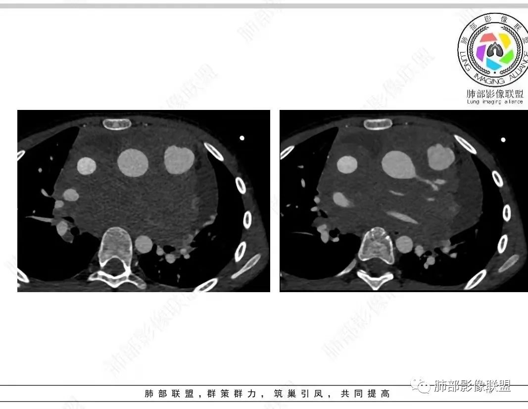 影像PPT - 【病例】纵隔/心脏毛霉菌病1例CT影像-15 影像PPT - 【病例】纵隔/心脏毛霉菌病1例CT影像-15