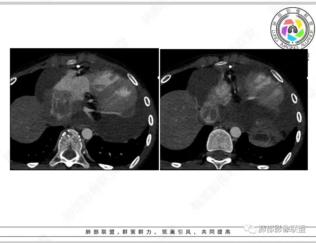 影像PPT - 【病例】纵隔/心脏毛霉菌病1例CT影像-21 影像PPT - 【病例】纵隔/心脏毛霉菌病1例CT影像-21