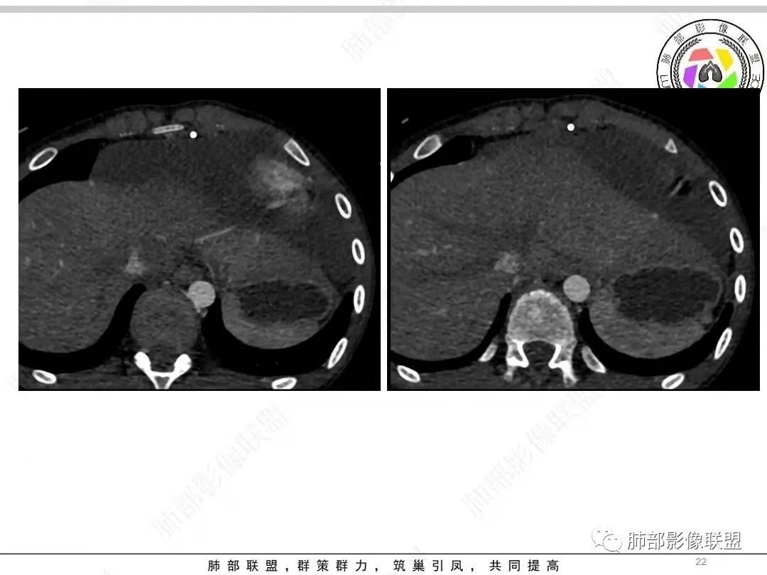 影像PPT - 【病例】纵隔/心脏毛霉菌病1例CT影像-1 影像PPT - 【病例】纵隔/心脏毛霉菌病1例CT影像-1