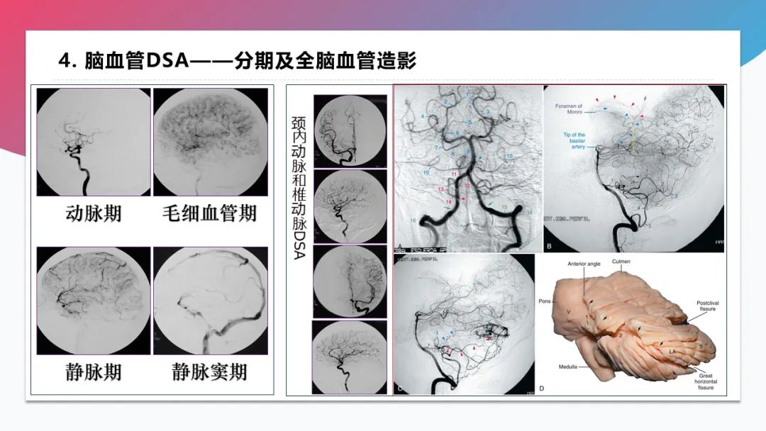 影像PPT - 【PPT】脑血管解剖-43 影像PPT - 【PPT】脑血管解剖-43