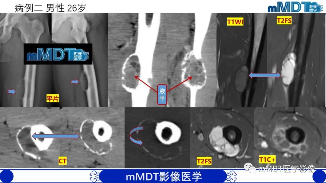影像PPT - 【PPT】傻傻分不清外观“皂泡样”骨肿瘤影像剖析-9