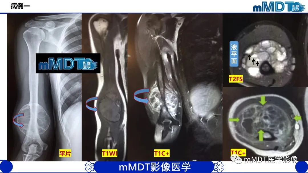 影像PPT - 【PPT】傻傻分不清外观“皂泡样”骨肿瘤影像剖析-8