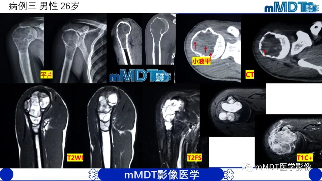 影像PPT - 【PPT】傻傻分不清外观“皂泡样”骨肿瘤影像剖析-10