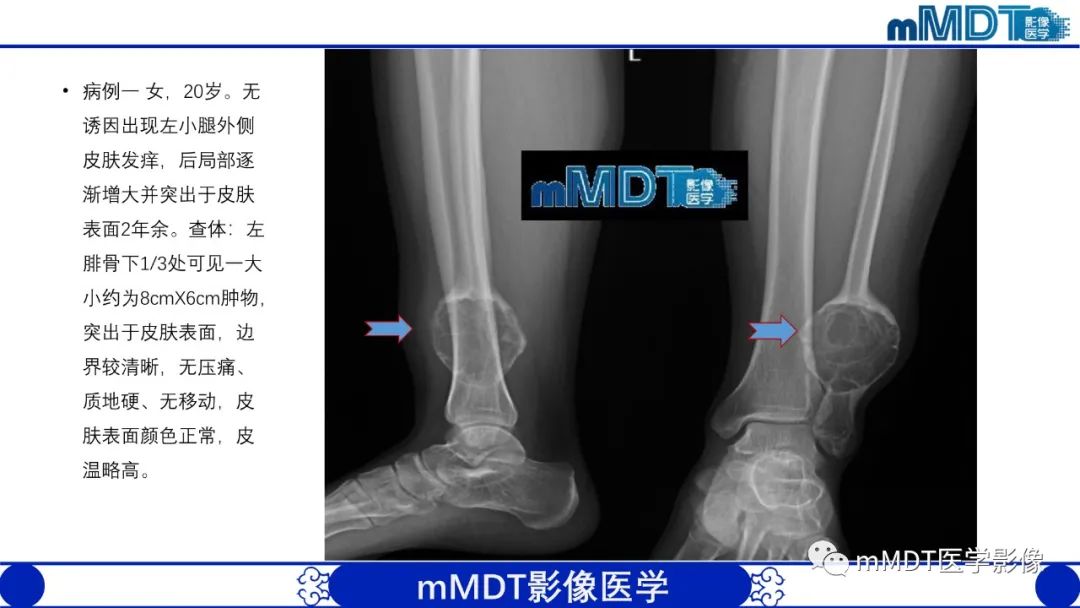 影像PPT - 【PPT】傻傻分不清外观“皂泡样”骨肿瘤影像剖析-17