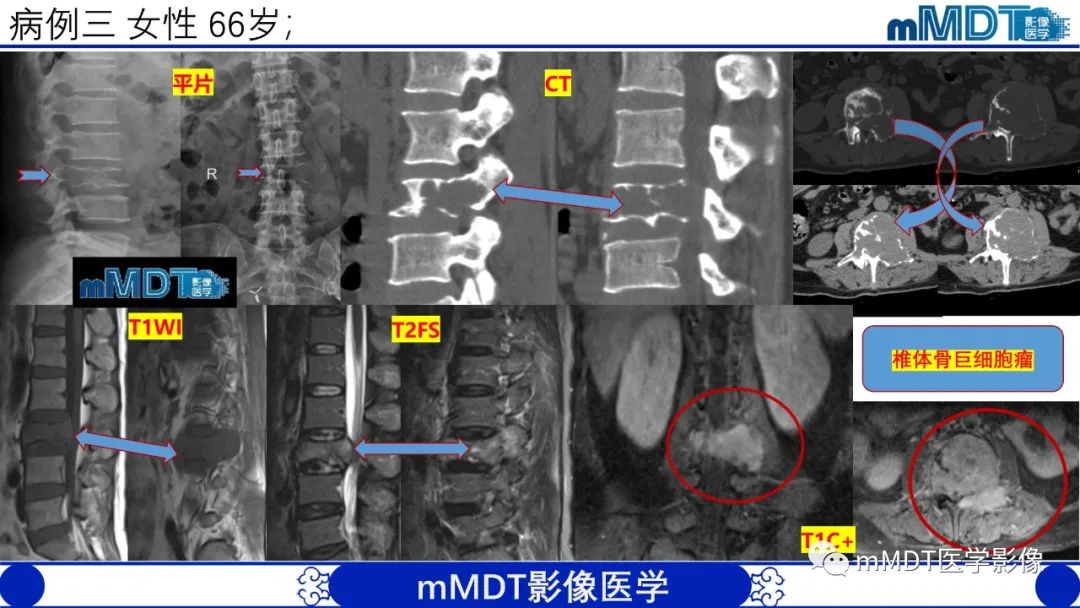 影像PPT - 【PPT】傻傻分不清外观“皂泡样”骨肿瘤影像剖析-30