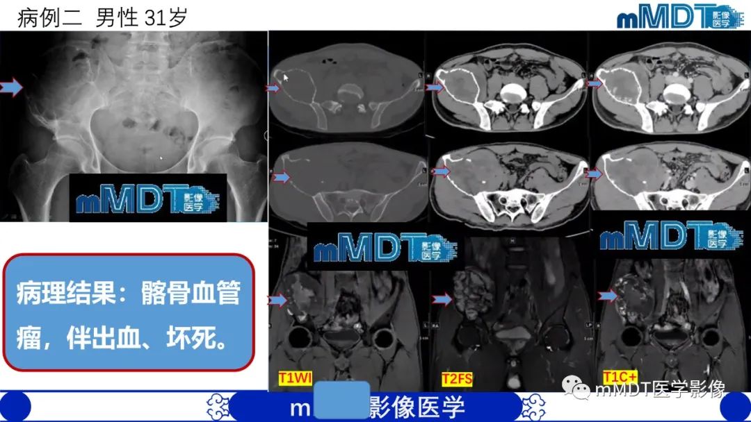 影像PPT - 【PPT】傻傻分不清外观“皂泡样”骨肿瘤影像剖析-14