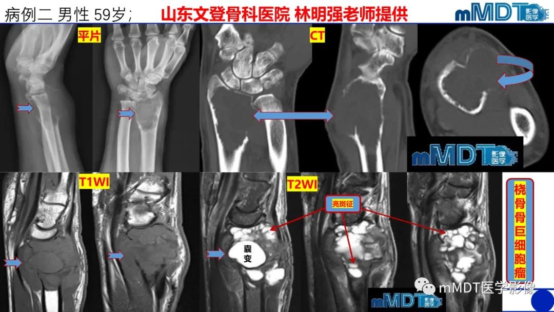 影像PPT - 【PPT】傻傻分不清外观“皂泡样”骨肿瘤影像剖析-29