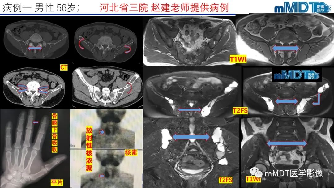 影像PPT - 【PPT】傻傻分不清外观“皂泡样”骨肿瘤影像剖析-34