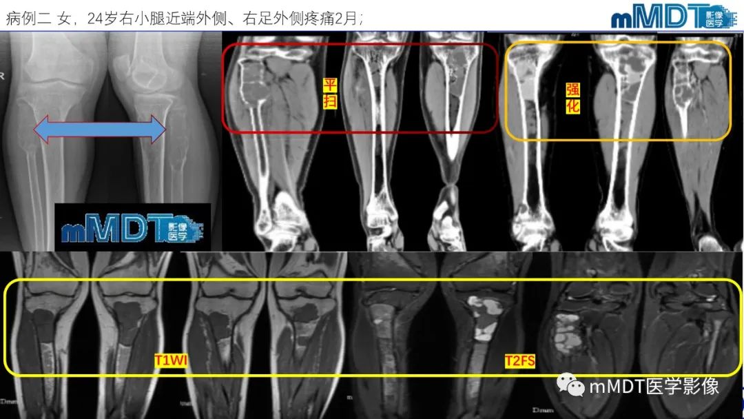 影像PPT - 【PPT】傻傻分不清外观“皂泡样”骨肿瘤影像剖析-35