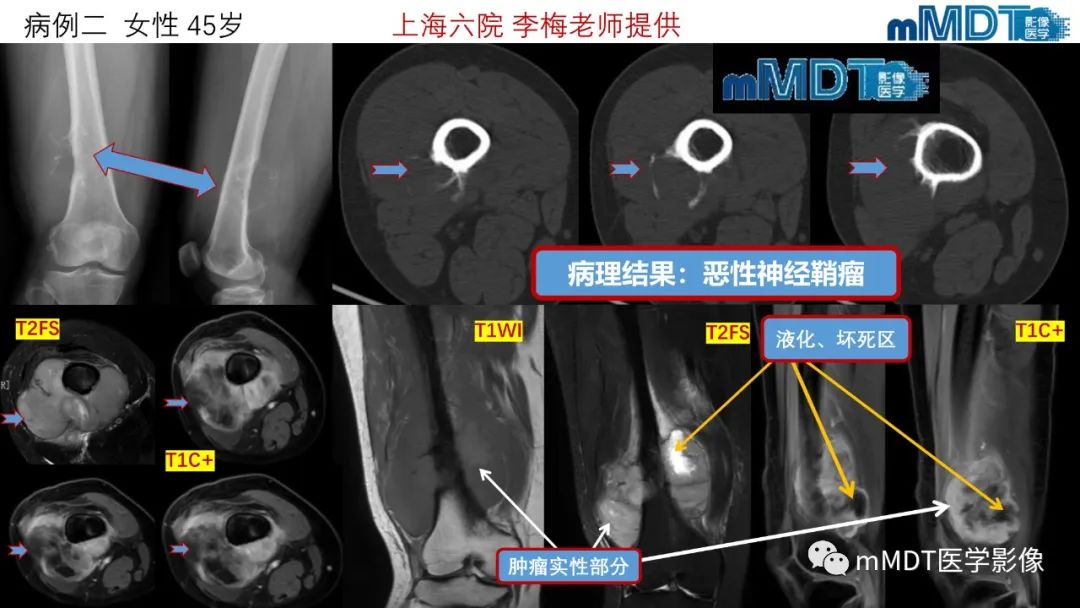 影像PPT - 【PPT】傻傻分不清外观“皂泡样”骨肿瘤影像剖析-18