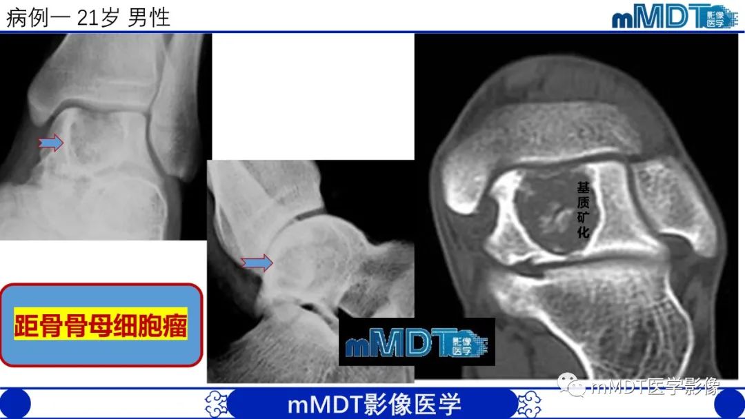 影像PPT - 【PPT】傻傻分不清外观“皂泡样”骨肿瘤影像剖析-22