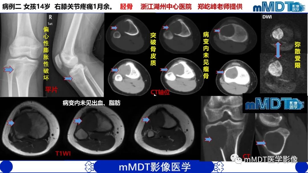 影像PPT - 【PPT】傻傻分不清外观“皂泡样”骨肿瘤影像剖析-43