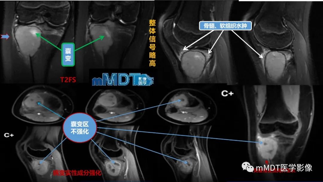 影像PPT - 【PPT】傻傻分不清外观“皂泡样”骨肿瘤影像剖析-44