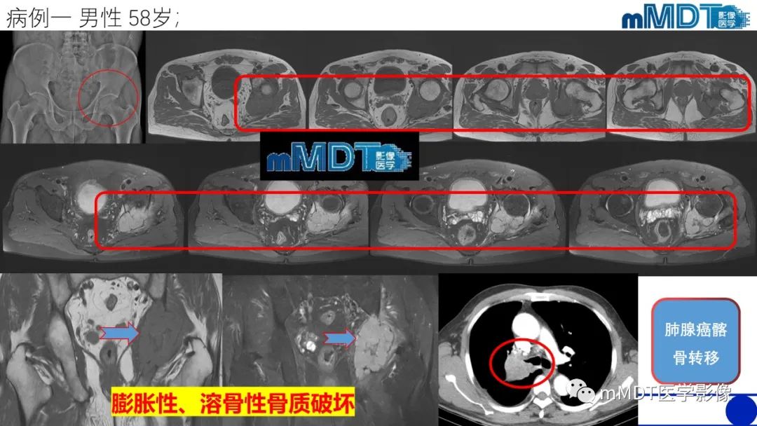 影像PPT - 【PPT】傻傻分不清外观“皂泡样”骨肿瘤影像剖析-52