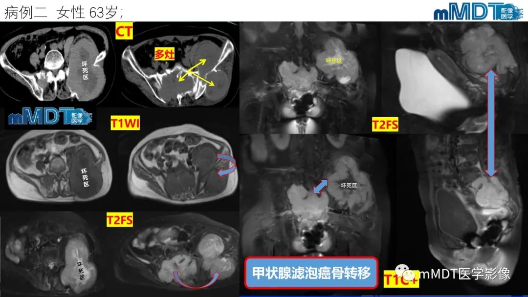 影像PPT - 【PPT】傻傻分不清外观“皂泡样”骨肿瘤影像剖析-53