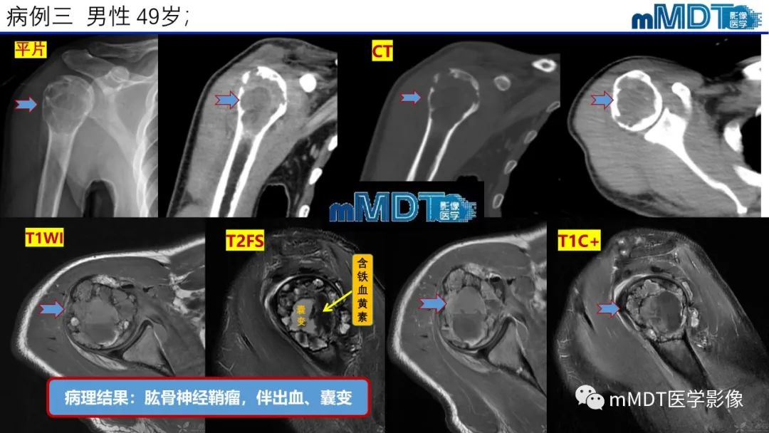 影像PPT - 【PPT】傻傻分不清外观“皂泡样”骨肿瘤影像剖析-3