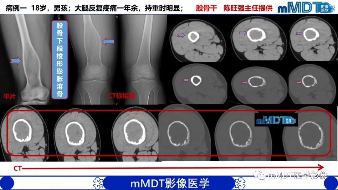影像PPT - 【PPT】傻傻分不清外观“皂泡样”骨肿瘤影像剖析-6