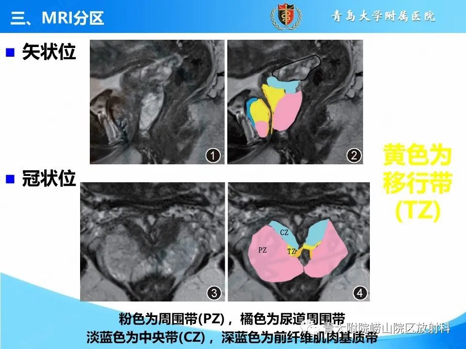 影像PPT - 【PPT】前列腺MRI解剖分区-9