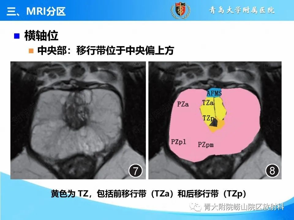 影像PPT - 【PPT】前列腺MRI解剖分区-11
