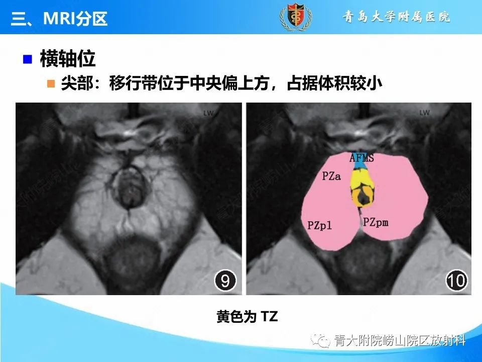 影像PPT - 【PPT】前列腺MRI解剖分区-12