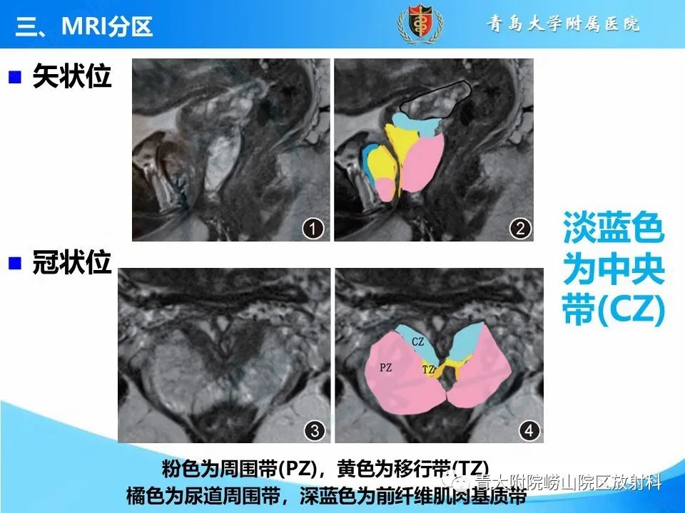 影像PPT - 【PPT】前列腺MRI解剖分区-14