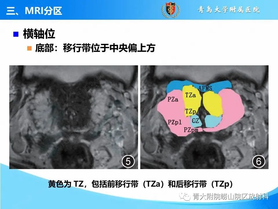 影像PPT - 【PPT】前列腺MRI解剖分区-10